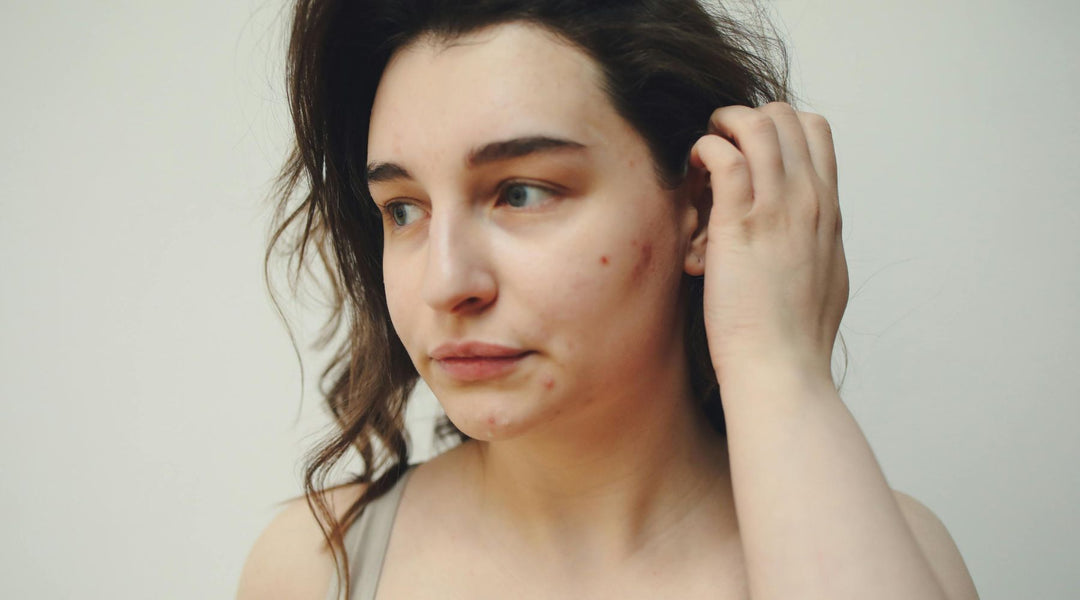 Hormonal Acne & Ayurvedic Balance: Natural Relief for Clearer Skin